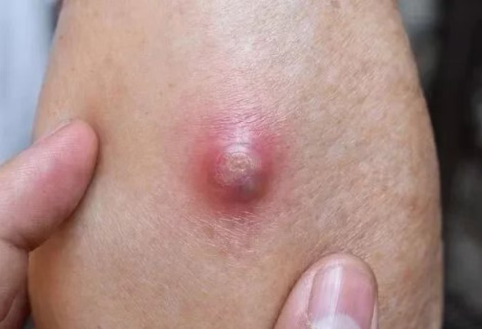 这种“红包”又痛又肿，硬挤还很危险！了解这些少跑医院